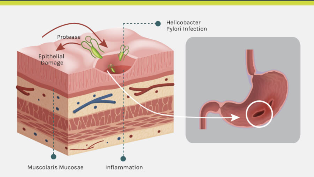 “幽門”危機(jī)怎么破？6點(diǎn)你必須知道的干貨